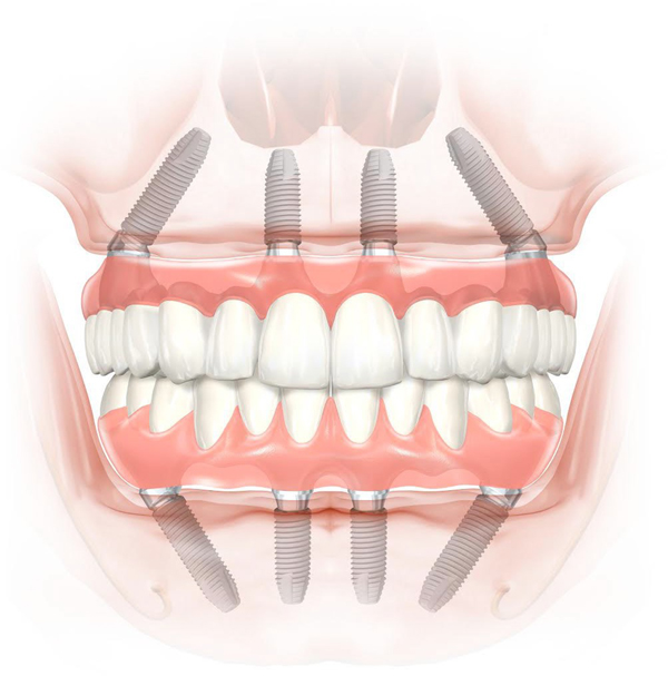 オールオン４(All-on-4)