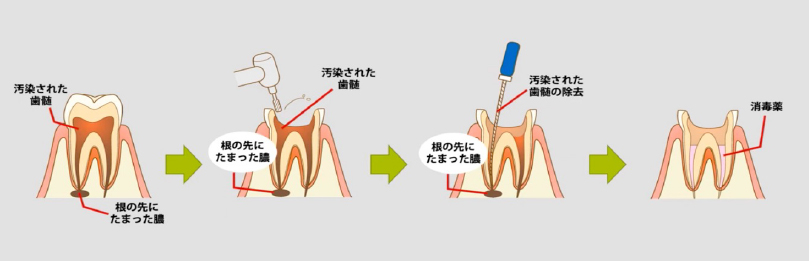 保険の根管治療の流れ