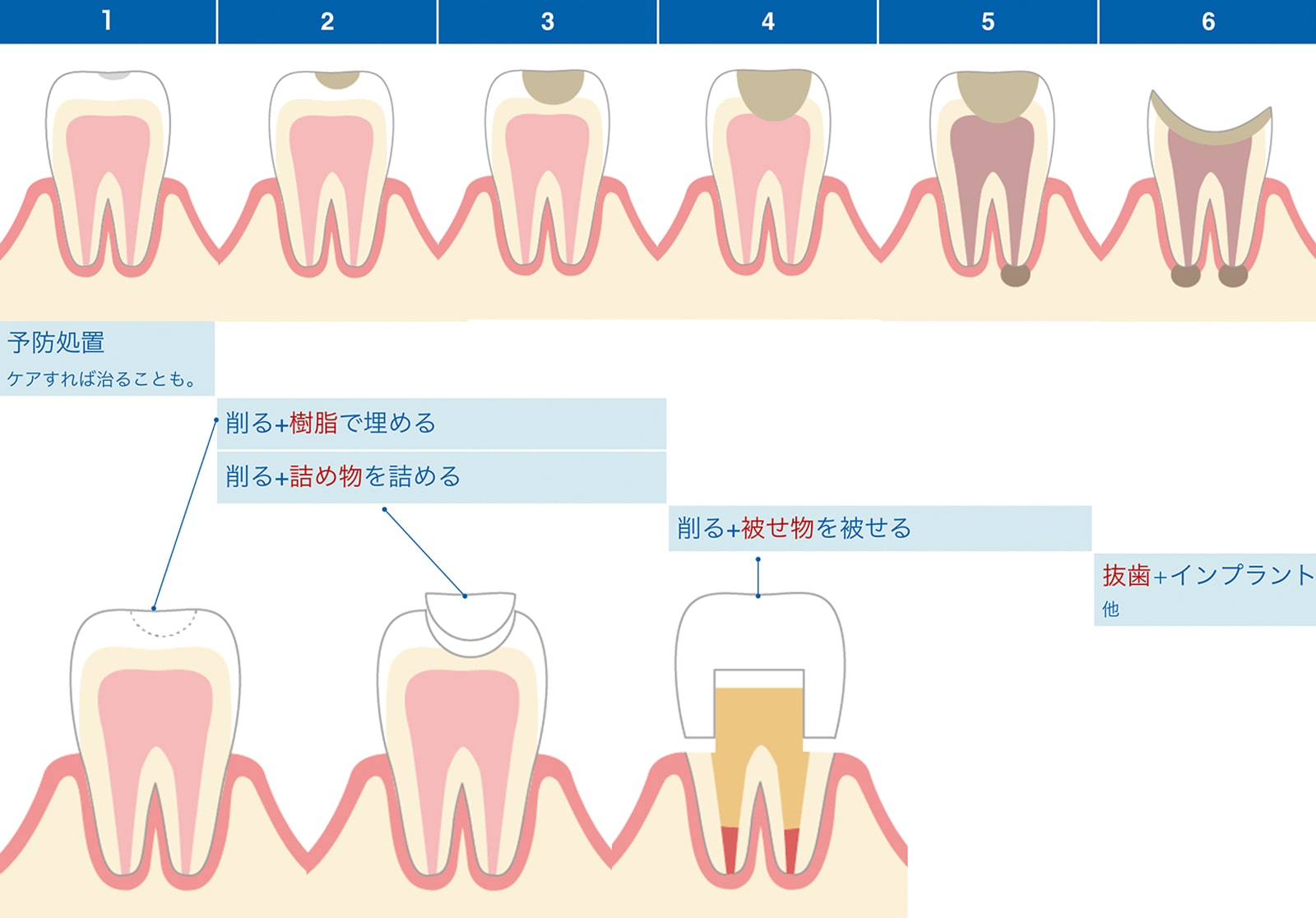 虫歯の治療について