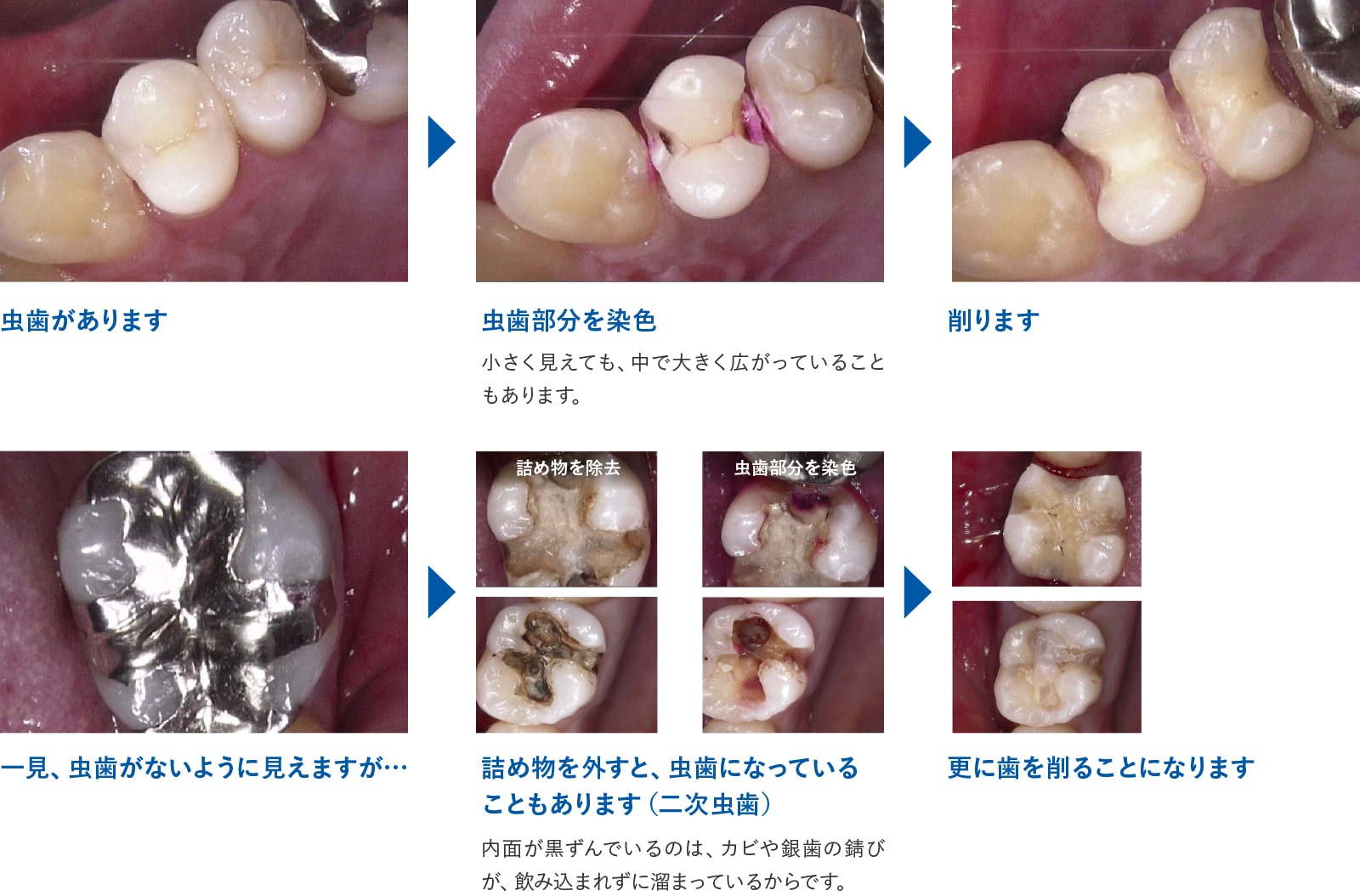 虫歯治療の流れ