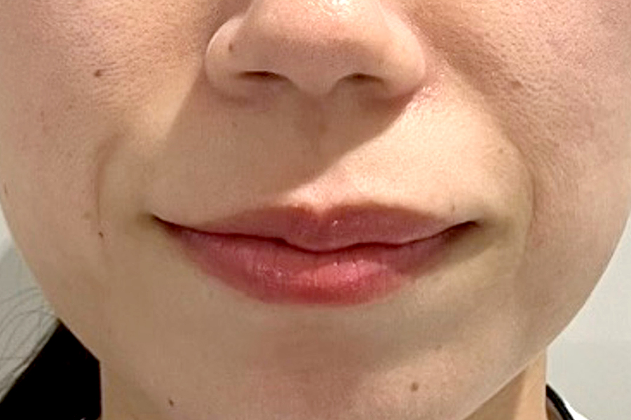 ヒアルロン酸術前写真