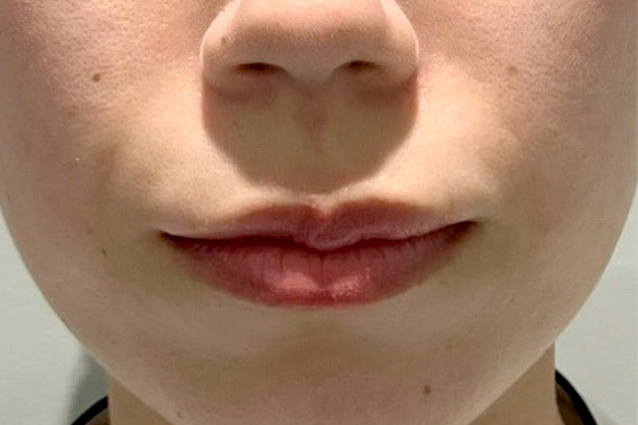 ヒアルロン酸術後写真