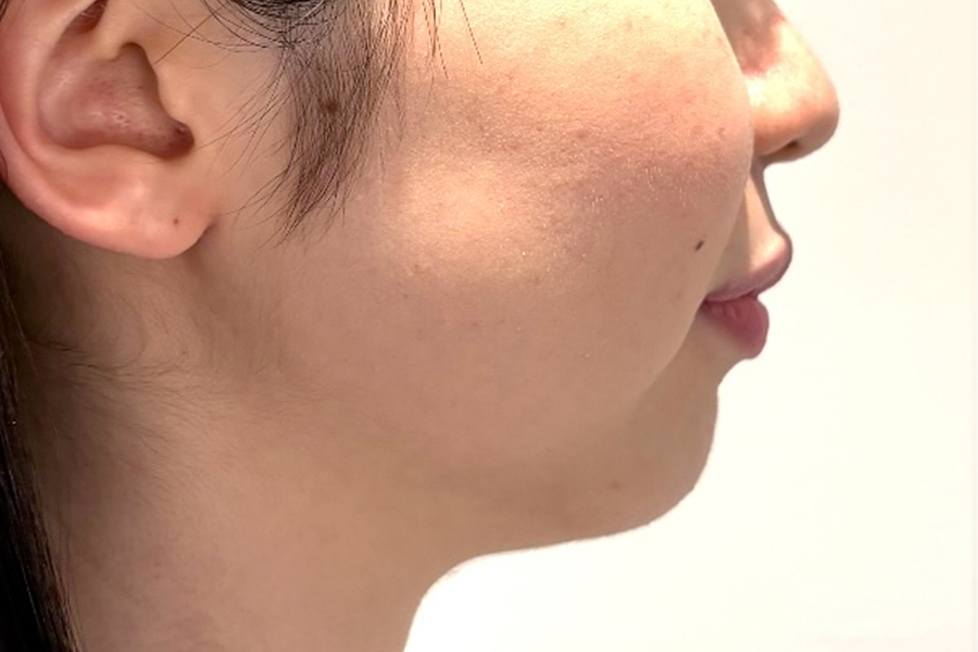 ヒアルロン酸術後写真