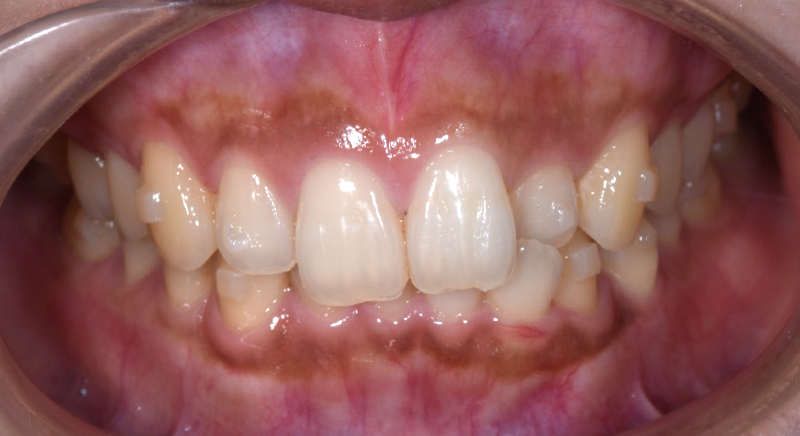 インビザライン術前写真