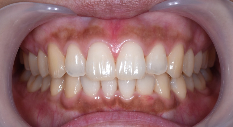インビザライン術後写真