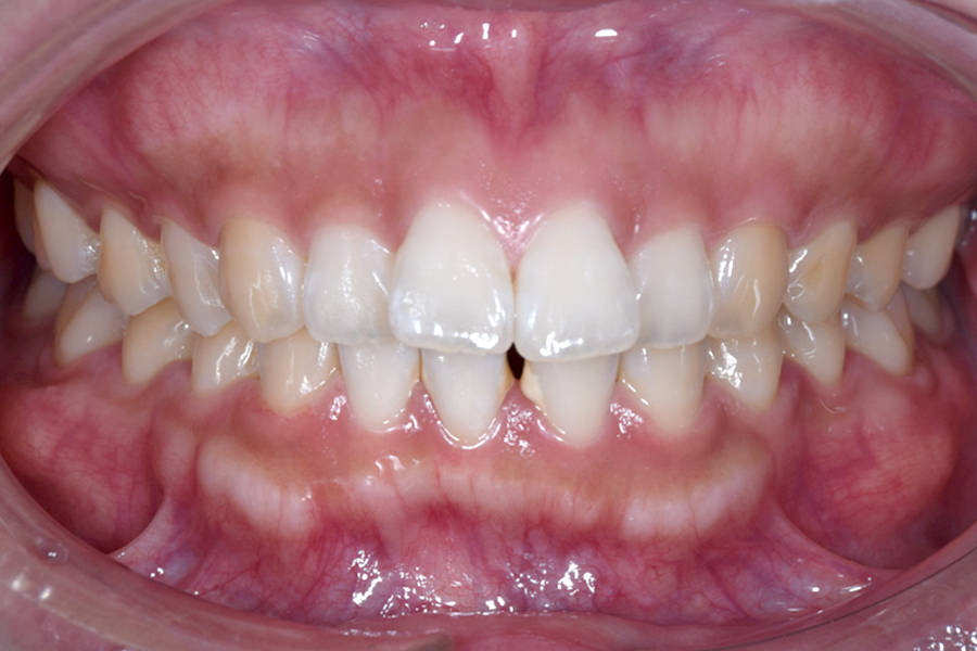 インビザライン術前写真