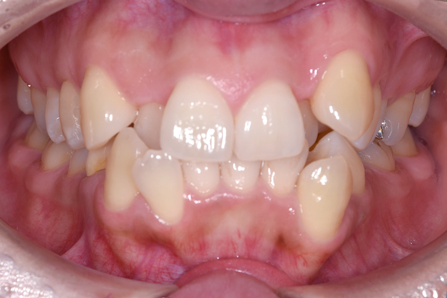 インビザライン術前写真