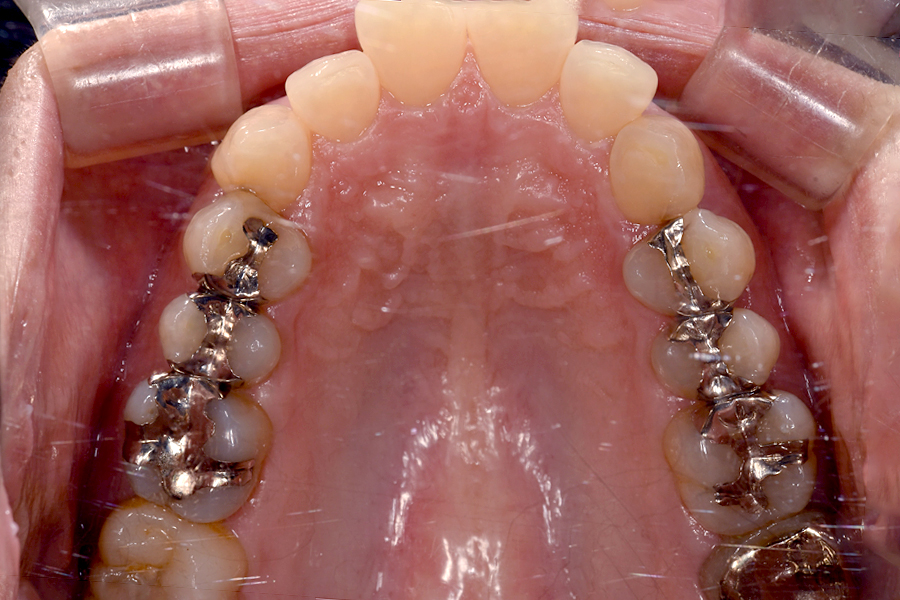 インビザライン術前写真