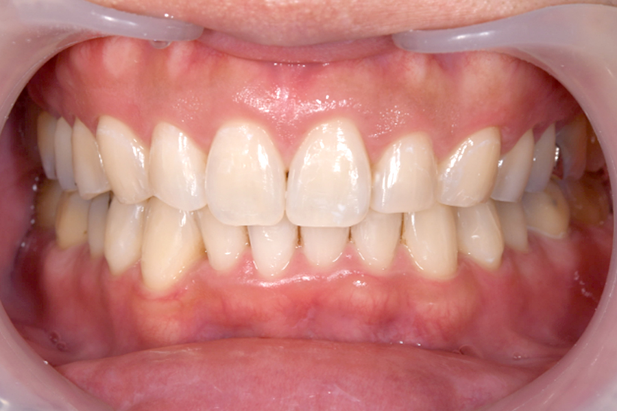 インビザライン術後写真