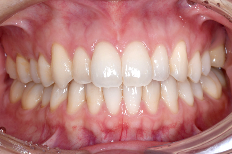 インビザライン術後写真