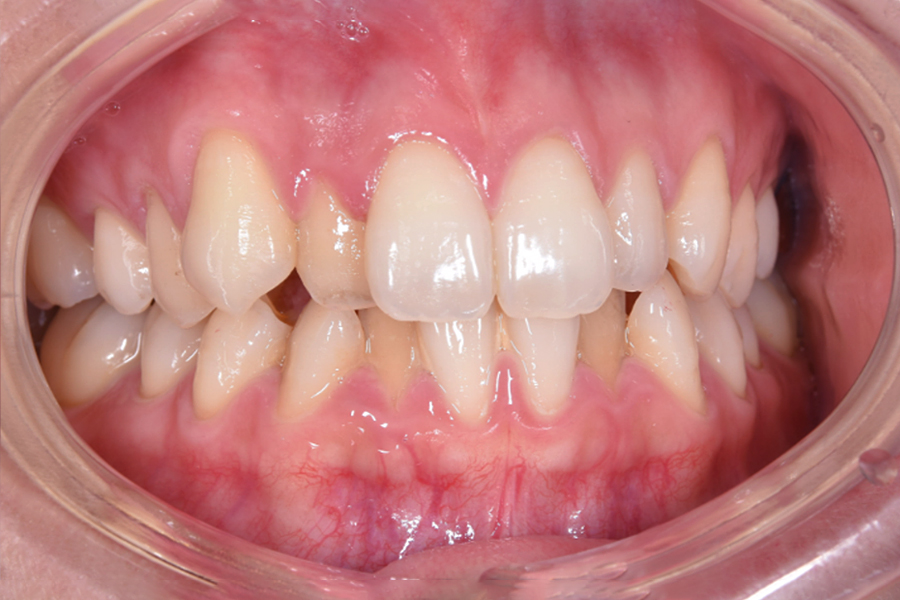 インビザライン術前写真