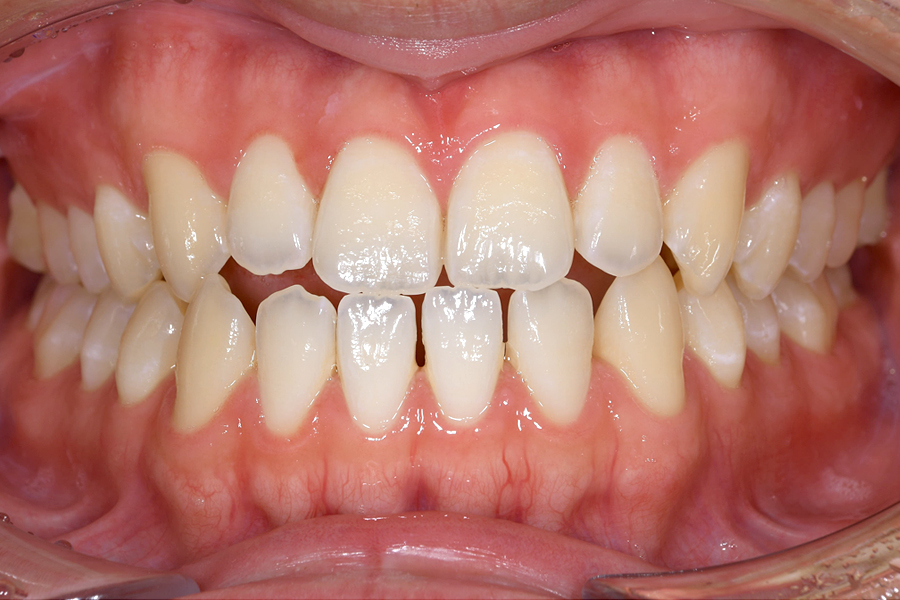 インビザライン術前写真