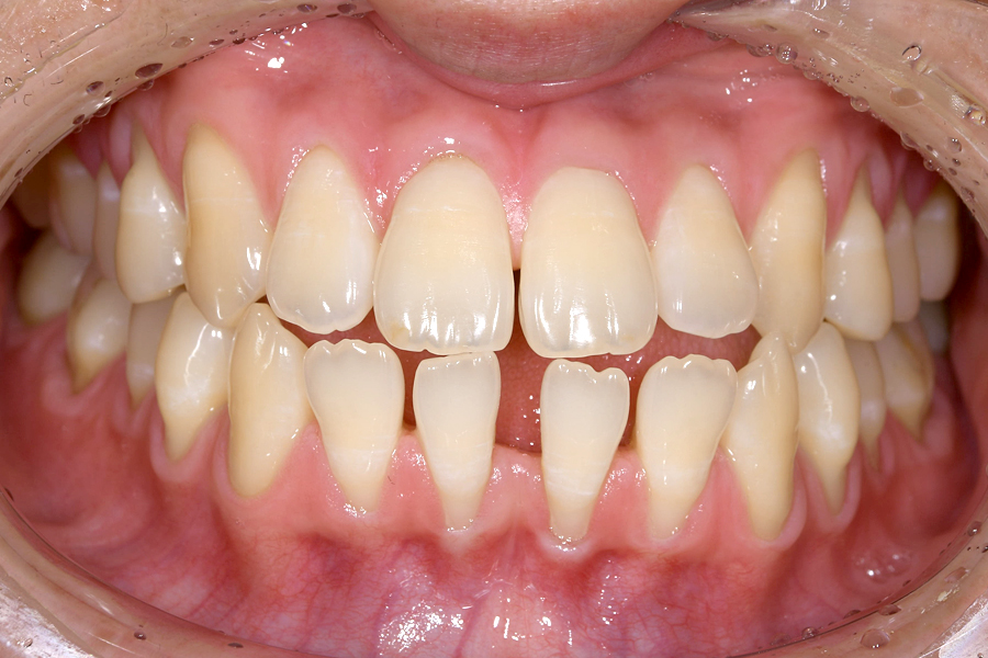 インビザライン術前写真