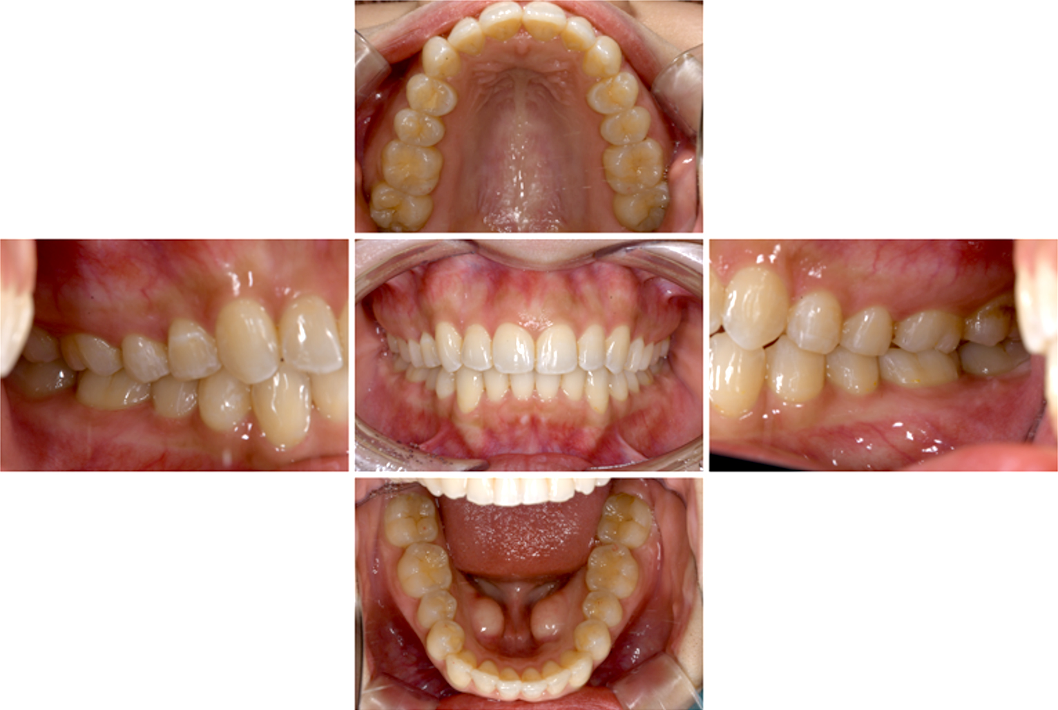 インビザライン術後写真