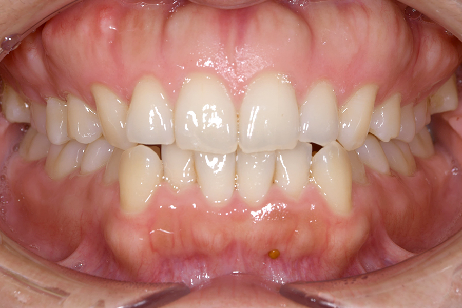 インビザライン術前写真