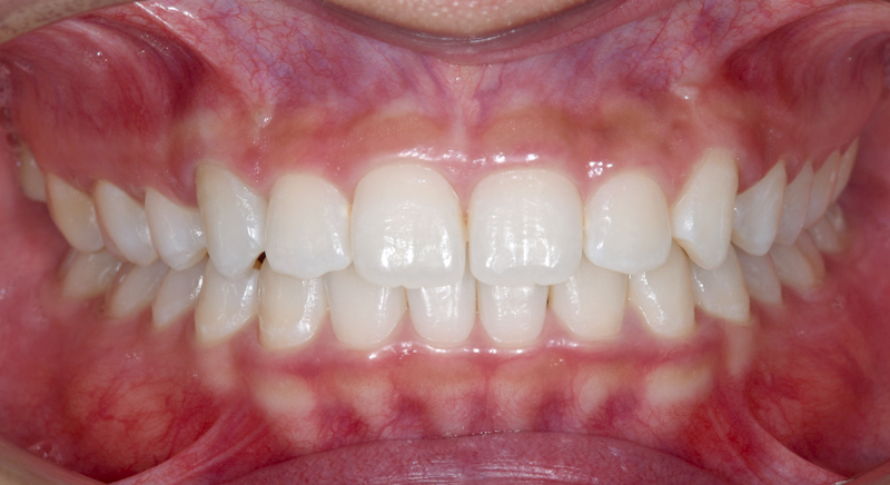 インビザライン術後写真