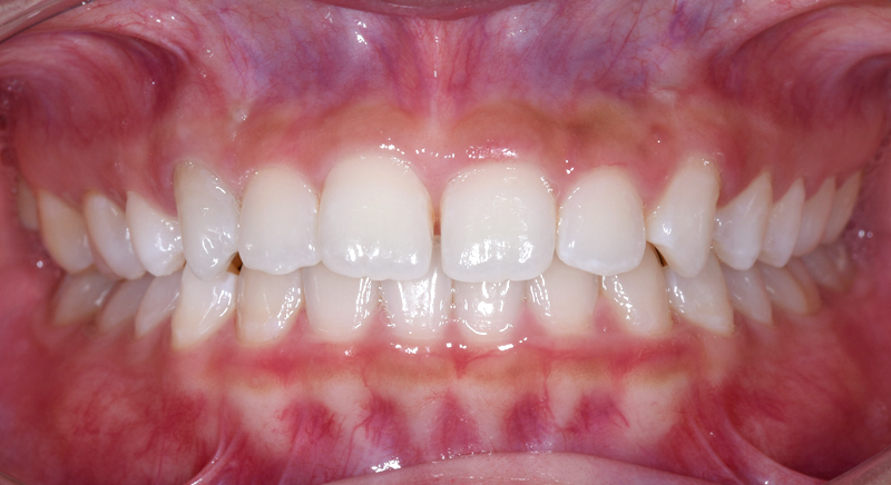 インビザライン術前写真