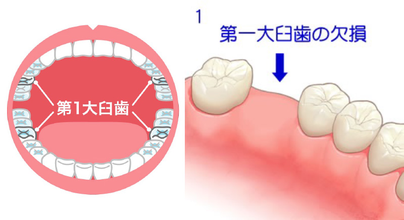 第1大臼歯