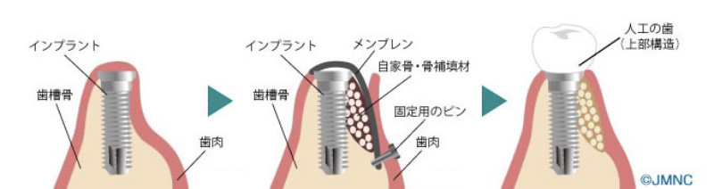 骨が足りない場合