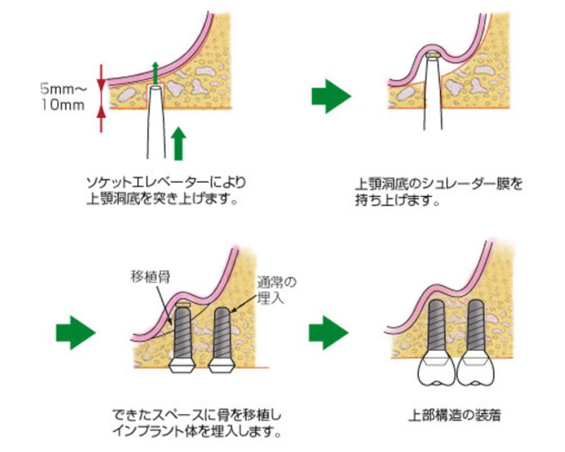 ソケットリフト