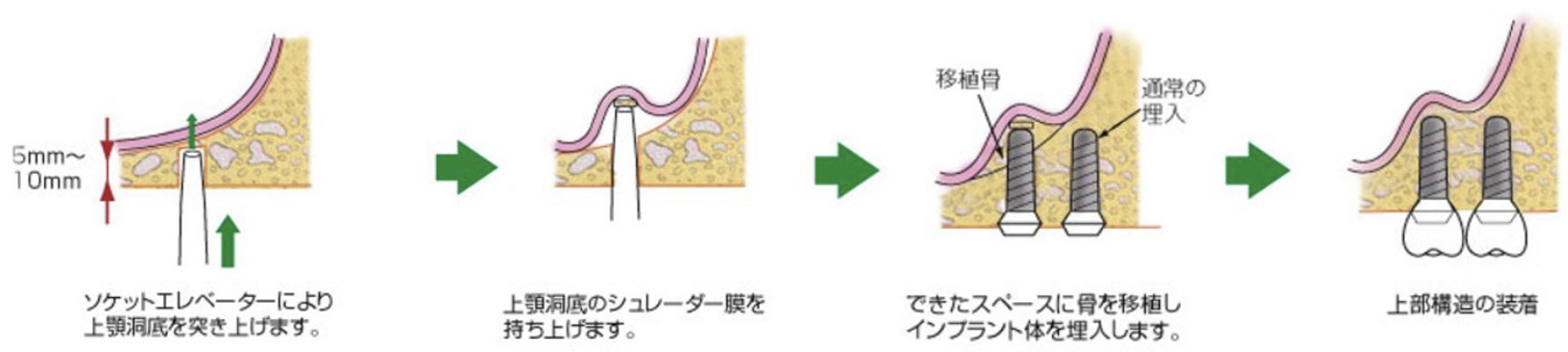 ソケットリフト