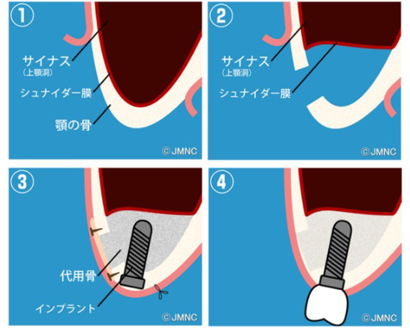 サイナスリフト