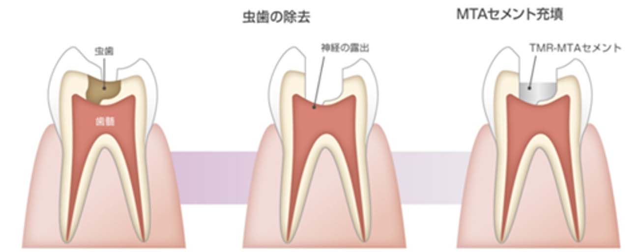 VPT（歯髄温存療法）