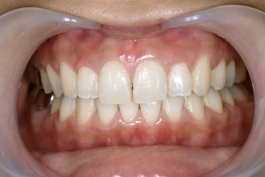 ホワイトニング術後写真