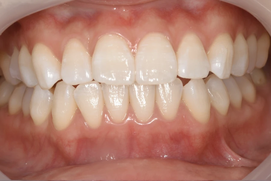 ホワイトニング術後写真