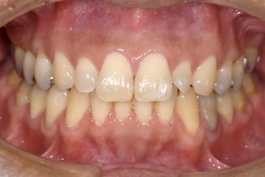 ホワイトニング術前写真