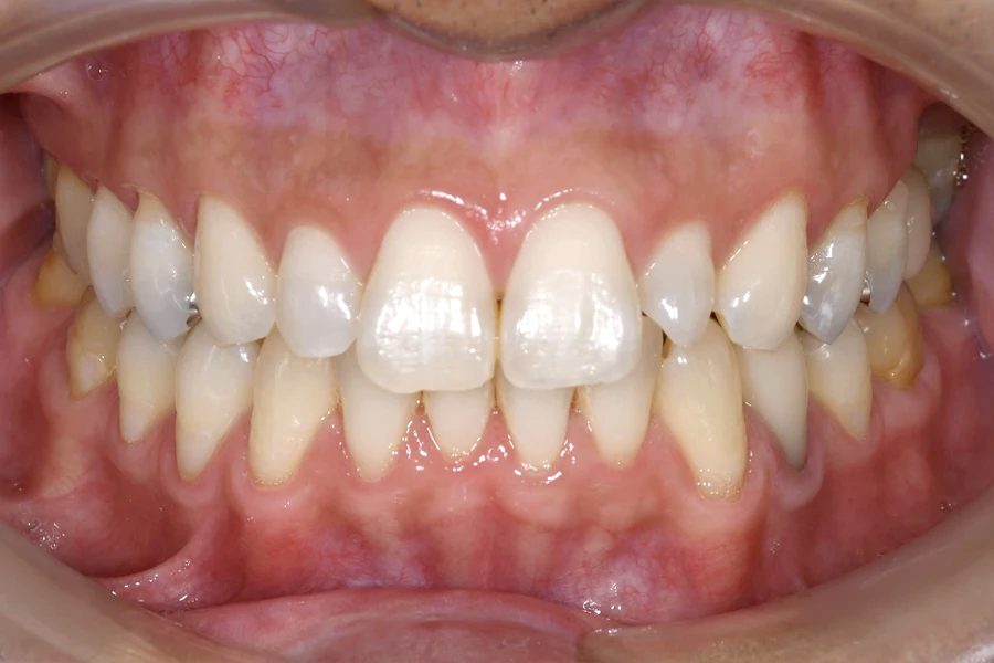 ホワイトニング術後写真