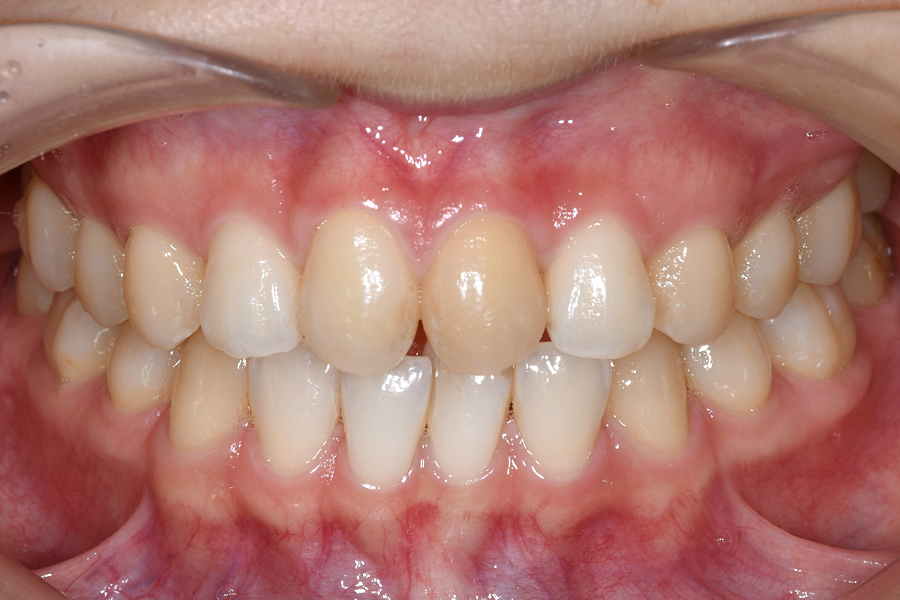 ホワイトニング術前写真