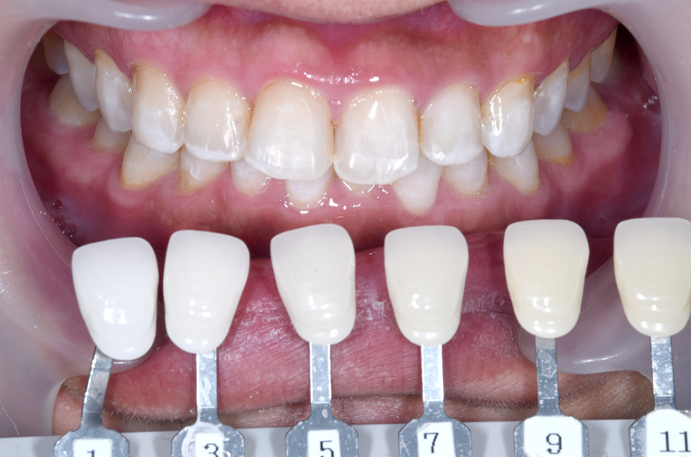 ホワイトニング術後写真
