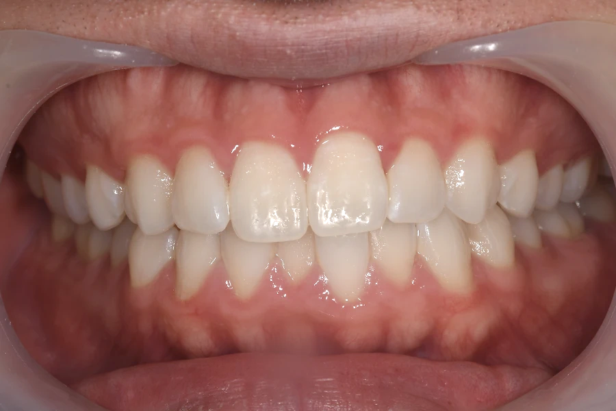 ホワイトニング術前写真