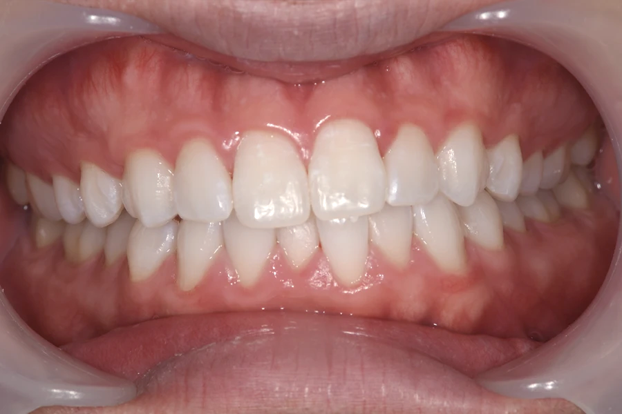 ホワイトニング術後写真